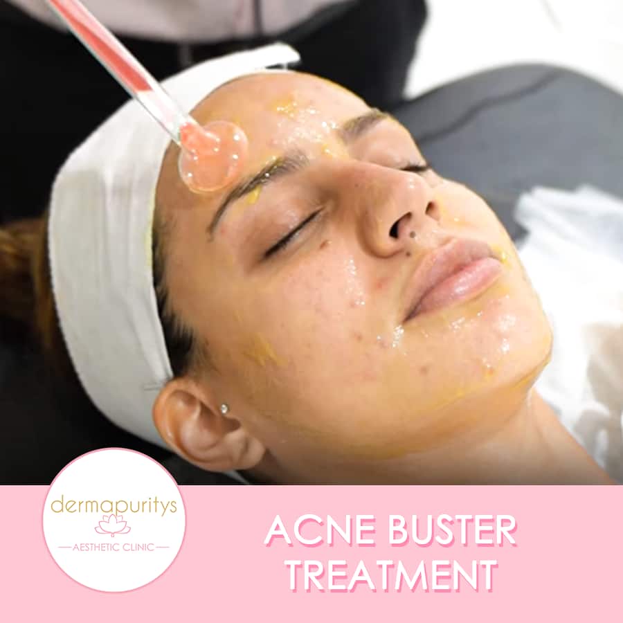 Acne Buster Treatment