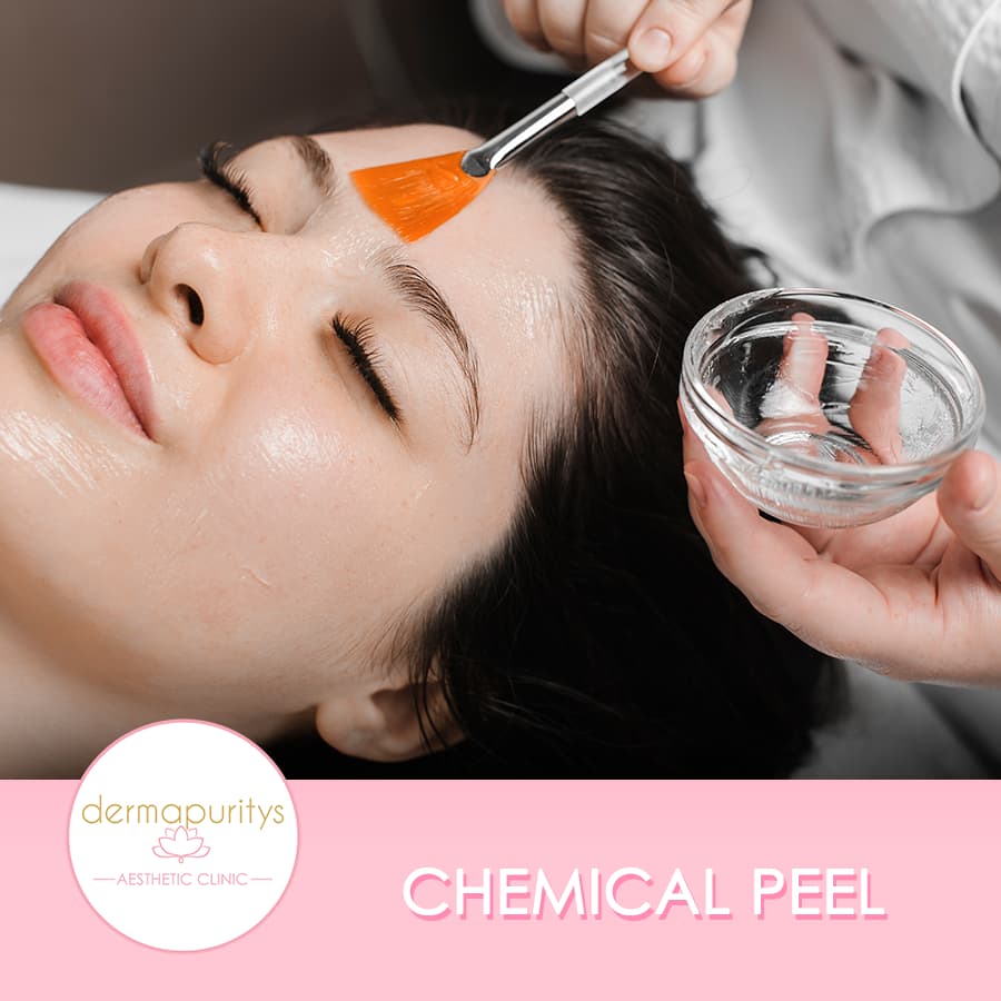 Chemical Peel