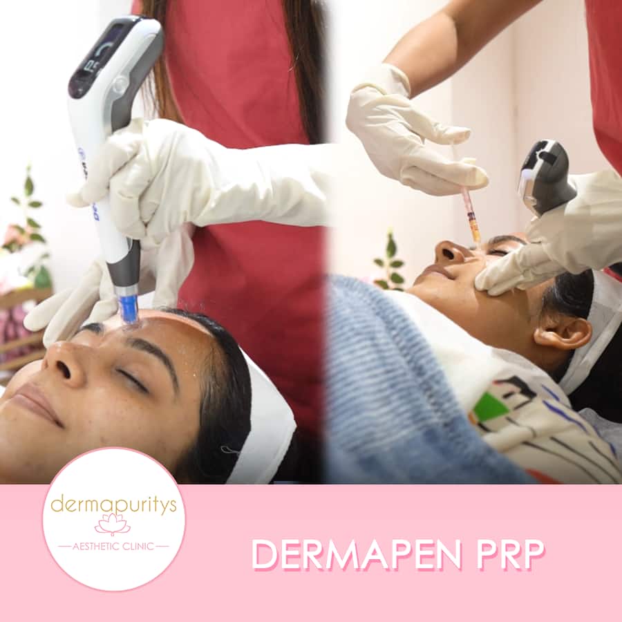 Dermapen Prp
