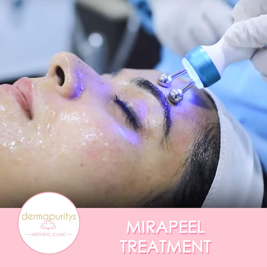 Mirapeel Treatment