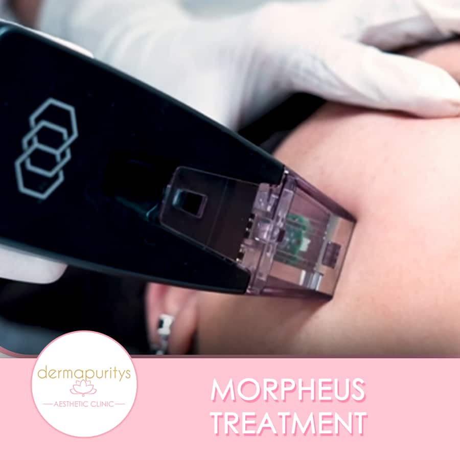 Morpheus Treatment