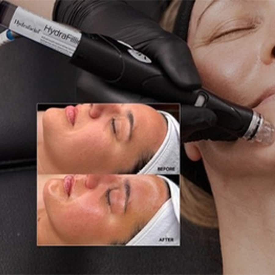 Hydra Facial