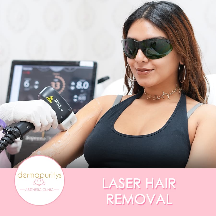 Laser hair removal